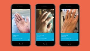 LEO Pharma-app diagnosticerer hudsygdomme bedre end lægen